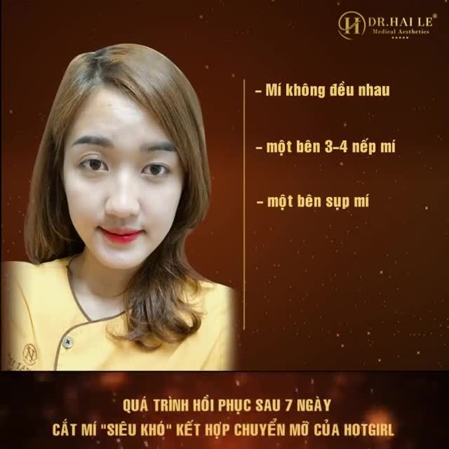7 NGÀY CẮT MÍ SIÊU KHÓ + KẾT HỢP CHUYỂN MỠ MẮT "Bí Quyết" Có Một Đôi Mắt Ấn Tượng!