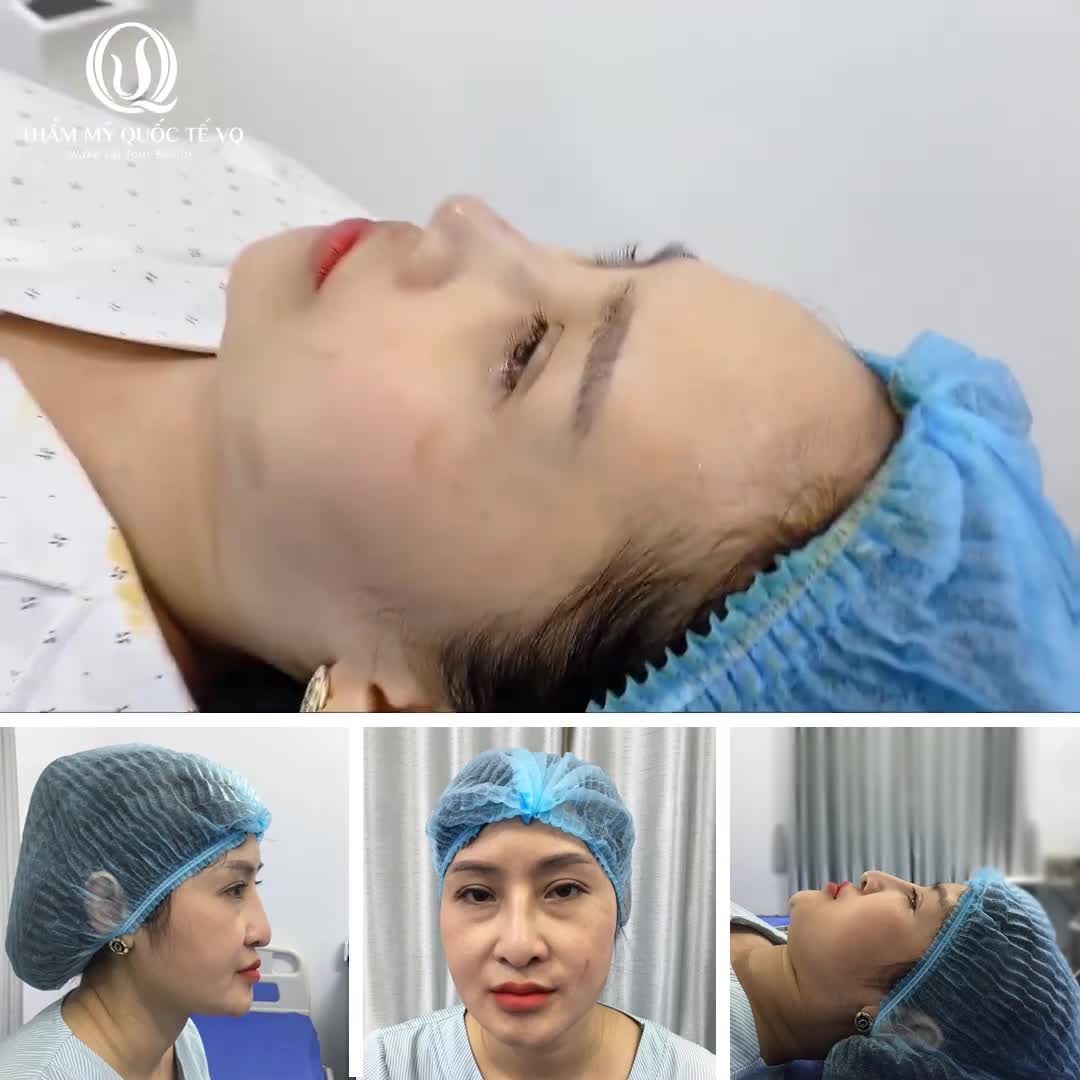 CẬN CẢNH KHÁCH HÀNG VỪA THỰC HIỆN XONG NÂNG MŨI SOFTLINE - GIẢI CỨU MŨI HỎNG - ĐẸP MỌI GÓC NHÌN, MŨI CAO THANH TÚ, KHÔNG SƯNG, BẦM TÍM.