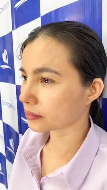 Dáng Mũi Sline 4D lên from cực đẹp sau 15 ngày cùng chiêm ngưỡng dáng mũi ĐẸP XUẤT SẮC tại TMV Gangwhoo