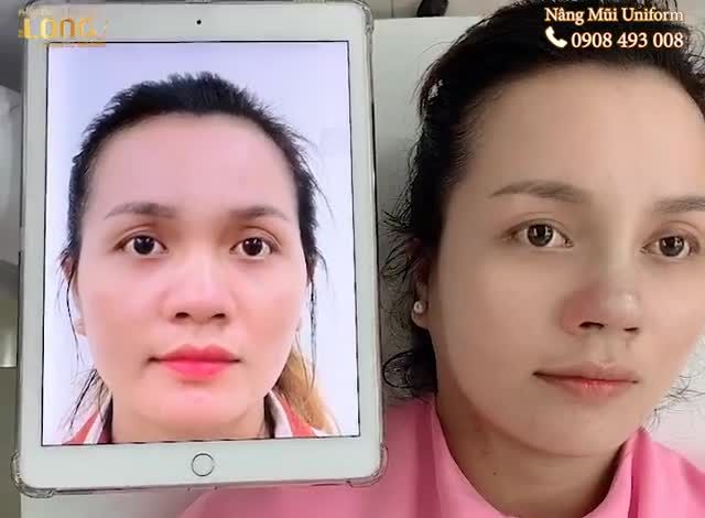 Một chiếc mũi với nhiều khuyết điểm sẽ khiến bạn thiếu tự tin trong giao tiếp cũng như cuộc sống