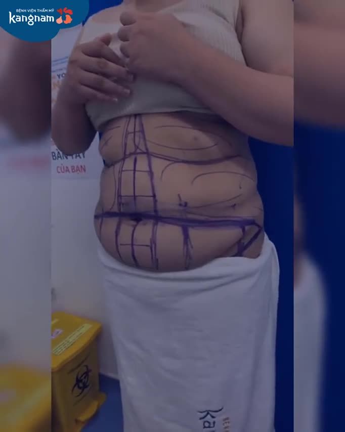 3 Ngấn MỠ ngồn ngộn "trường tồn" bao năm
