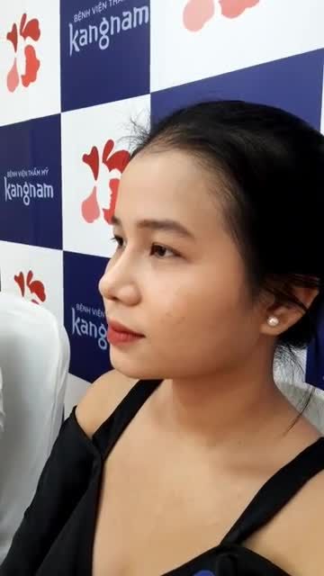 KHÁCH HÀNG THỰC HIỆN DỊCH VỤ NÂNG MŨI CẤU TRÚC SLINE 4D + CẮT CÁNH MŨI TÁI KHÁM SAU 1 THÁNG