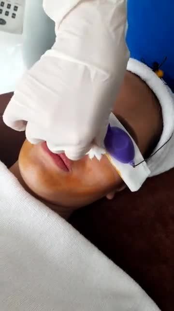 Quy Trình Chiếu Đèn Nano Skin Của Liệu Trình Điều Trị Mụn - Khách Hàng Thực Hiện Lần Thứ 2