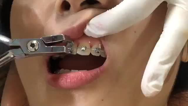 BUNG LỤA CHO KHÁCH HÀNG RĂNG HÔ - KHẤP KHỂNH NHẸ