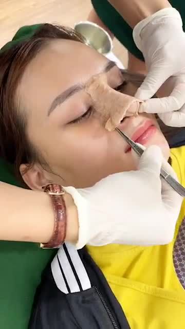 Cận cảnh quá trình tháo nẹp mũi tại Bác Sĩ Khải