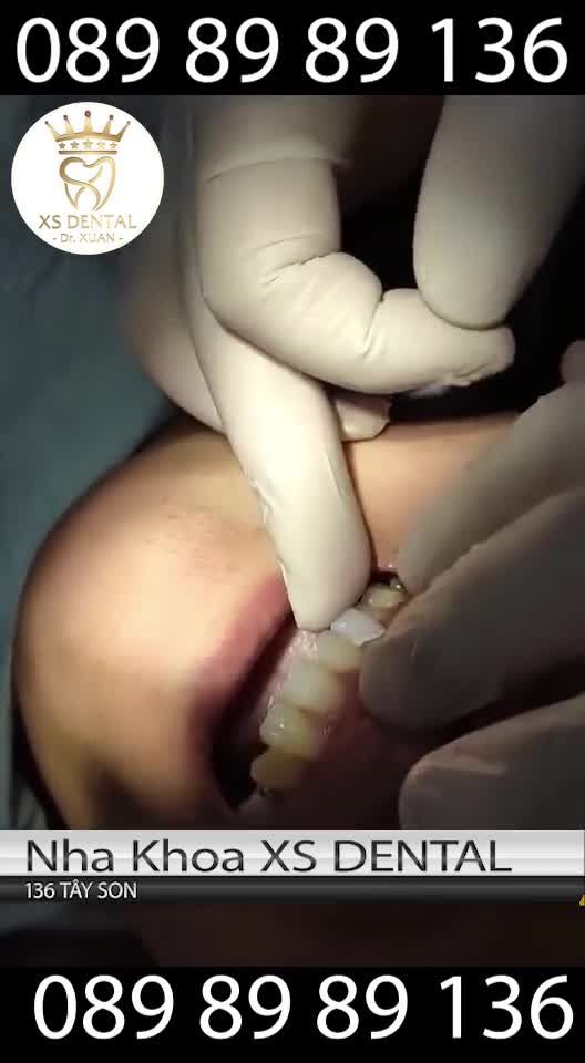 Có khi bạn chưa biết quy trình - Phương pháp bọc chup sứ đơn lẻ có tác dụng ra sao