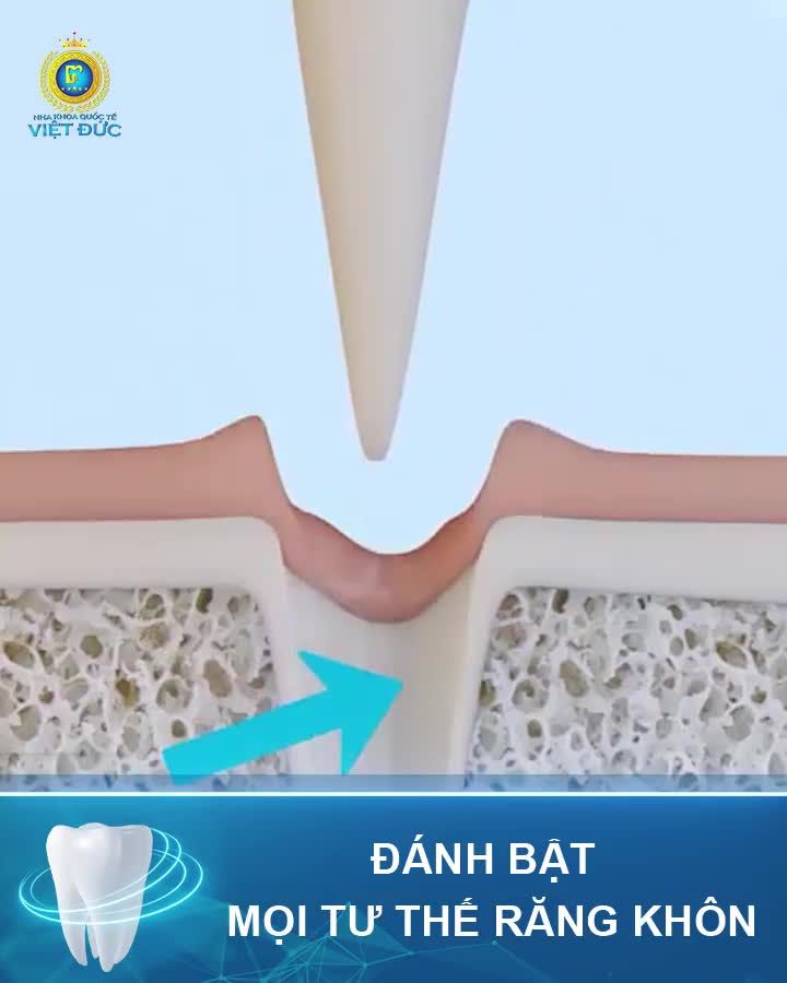 CÔNG NGHỆ NHỔ RĂNG SỐ 1 THẾ GIỚI ỨNG DỤNG ĐỘC QUYỀN TẠI NHA KHOA QUỐC TẾ VIỆT ĐỨC