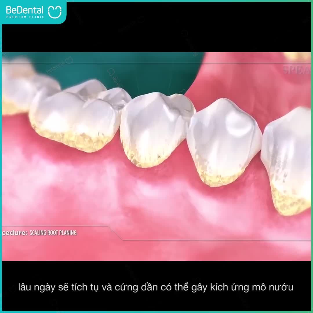 KHÁI NIỆM VỀ CAO RĂNG