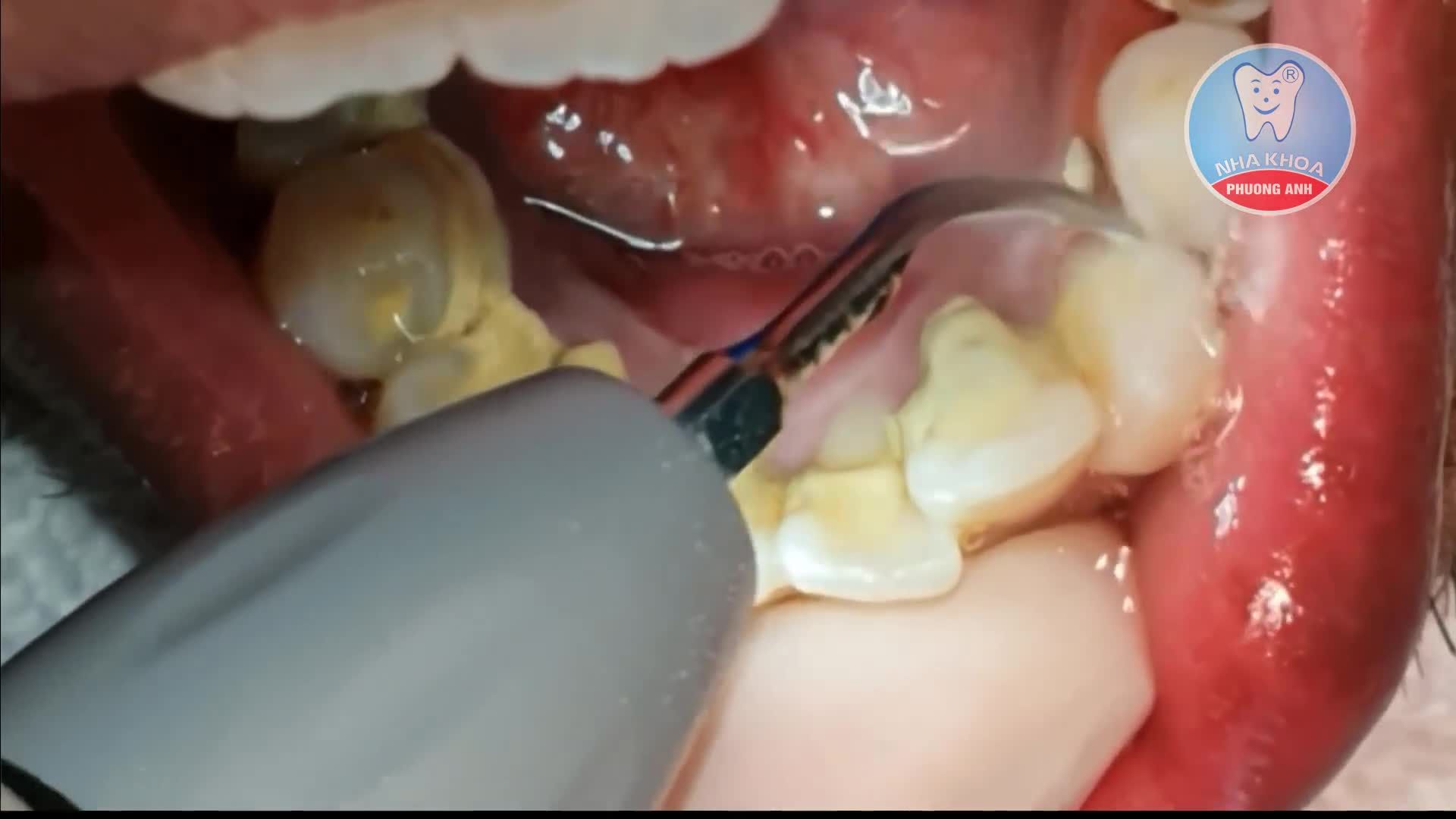 LẤY XONG CẢM GIÁC THOẢI MÁI