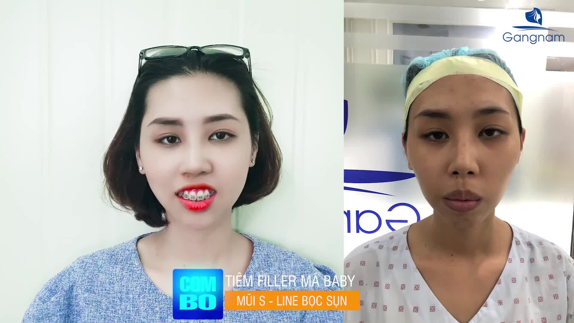 MÁ HÓP - MŨI NHIỀU KHUYẾT ĐIỂM THÌ LÀM SAO?