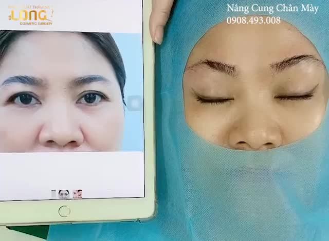 Nâng Cung Chân Mày nâng cơ giúp trẻ hoá đôi mắt