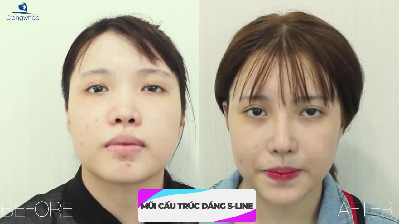 NÂNG MŨI CẤU TRÚC S-LINE - KHẮC PHỤC TÌNH TRẠNG MŨI TẸT, SÓNG MŨI THẤP
