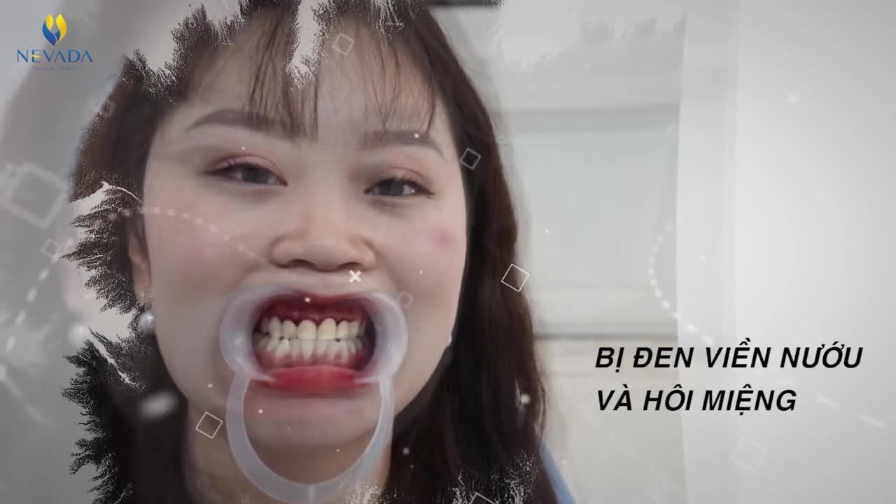 RĂNG SỨ BỌC HỎNG LỘT XÁC NHƯ THẾ NÀO SAU KHI ĐẾN NEVADA