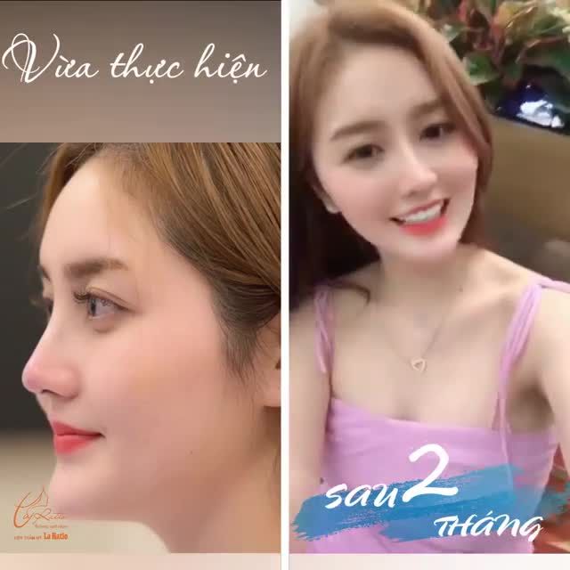 "THẦN TIÊN TỈ TỈ" CỦA LA RATIO TÁI KHÁM MŨI SAU 2 THÁNG