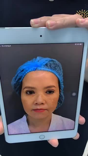 Ca nâng mũi cấu trúc thứ 14 HOÀN THÀNH