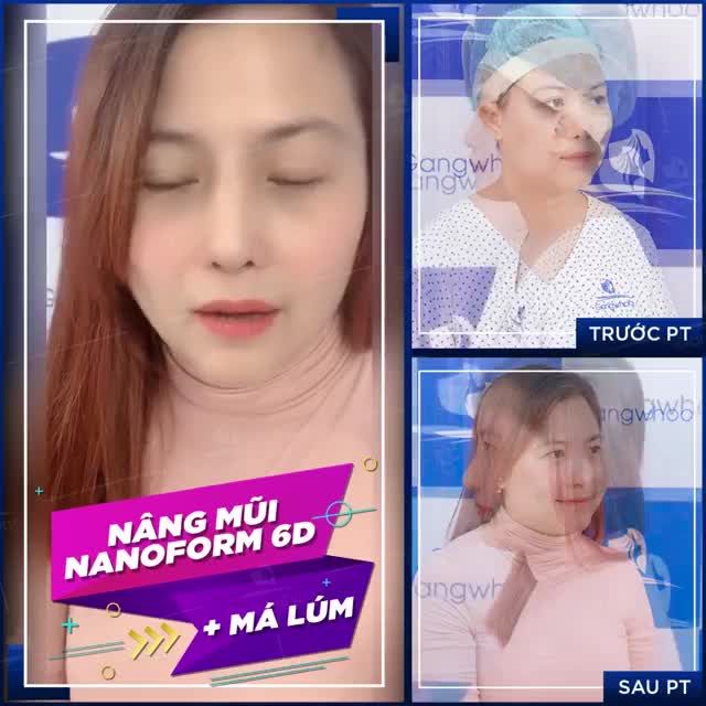 KẾT QUẢ ƯNG Ý, THĂNG HẠNG NHAN SẮC ĐỈNH CAO VỚI COMBO NÂNG MŨI CẤU TRÚC 6D + MÁ LÚM ĐỒNG TIỀN DUYÊN DÁNG