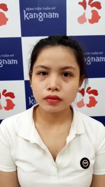 Môi xinh xắn tự tin cười tươi nhờ dịch vụ thu mỏng môi, khắc phục khuyết điểm sẹo môi xấu