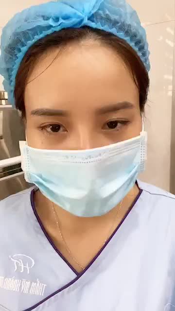 Cải thiện gốc mũi thấp tẹt, đầu mũi tròn hếch, không có chóp mũi cho ca mũi số 92/8 sau nâng mũi Sline.