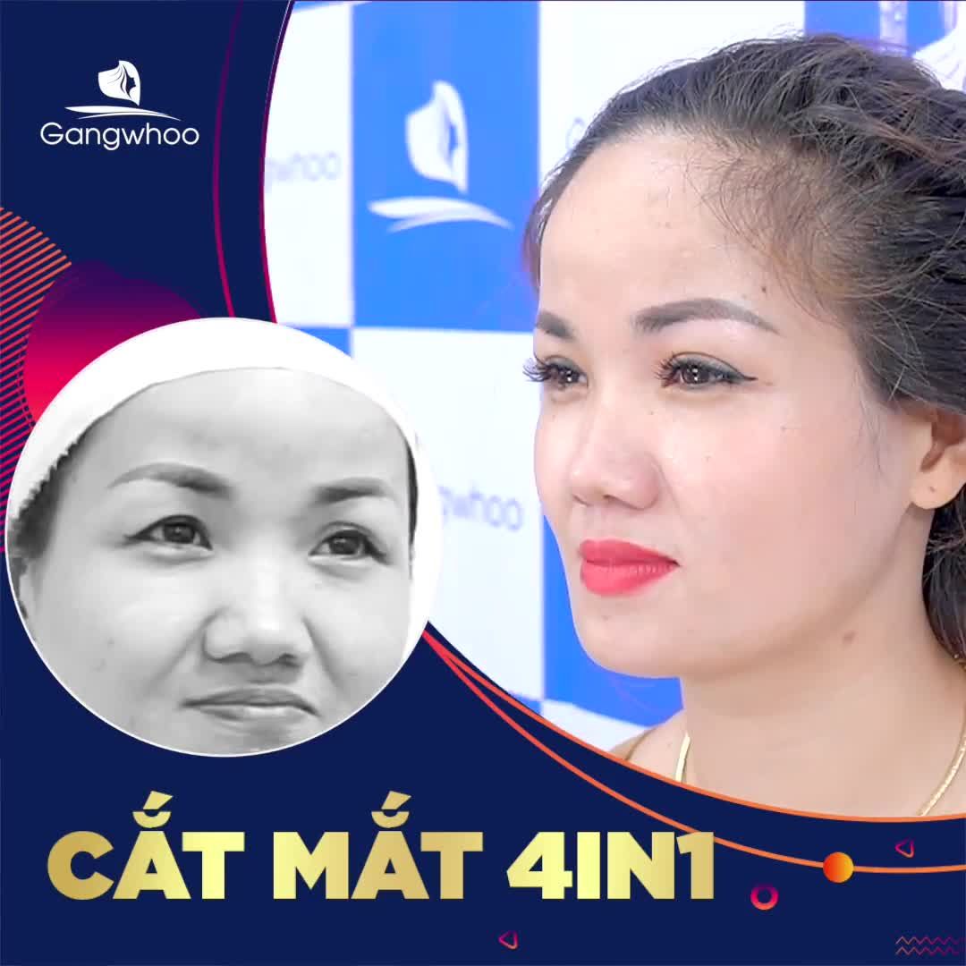 CA XỬ LÝ MẮT HỎNG NHỜ CẮT MÍ 4IN1 ĐƯỢC KHÁCH HÀNG ĐÁNH GIÁ ĐIỂM 10