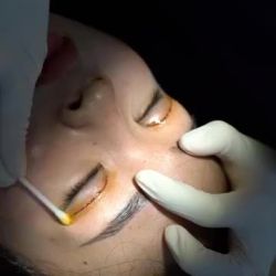 Cùng xem quá trình cắt chỉ mắt sau khi cắt mí được 7 ngày