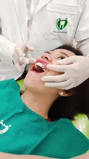 DÁN SỨ VENEER: CHE KHUYẾT ĐIỂM – KHOE NỤ CƯỜI DUYÊN