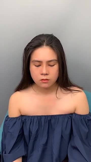 Mời khách hàng chiêm ngưỡng kết quả sau 10 ngày nâng mũi cấu trúc tại trung tâm bs Đỗ Quang Khải