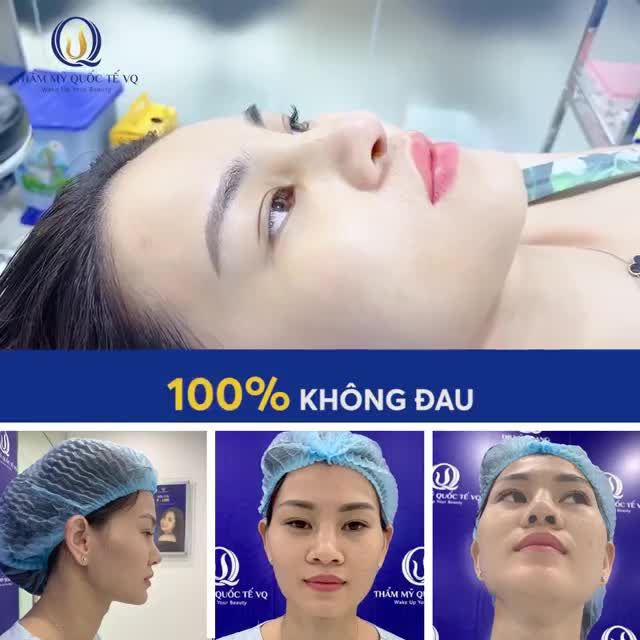 10 ngày sau NÂNG MŨI SOFTLINE - Nữ khách hàng xinh đẹp, rạng ngời.