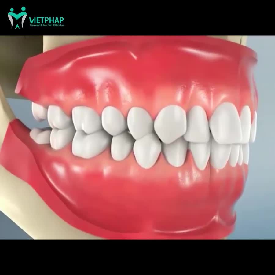 CÔNG NGHỆ ĐỘT PHÁ - XÓA BỎ RĂNG KHÔN