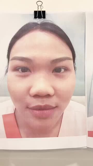 MŨI CẤU TRÚC SURGIFORM CHO NỀN MŨI TO NGẮN