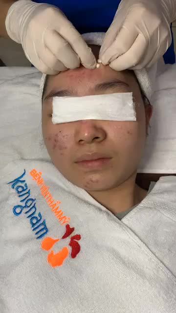Mụn viêm Mụn bọc Mụn ẩn Điều trị thế nào