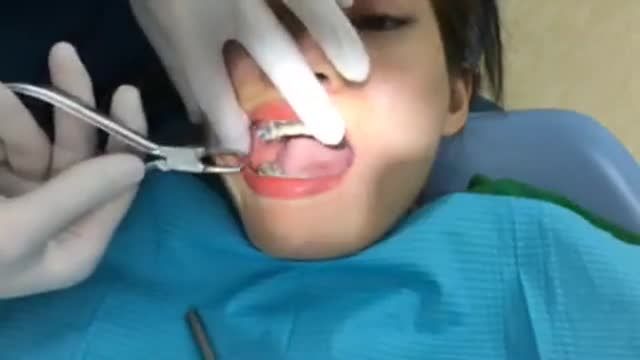 Quá trình tháo mắc cài hoàn thành quá trình chỉnh nha cho bạn Yến tại Nha Khoa Thuỳ Anh.