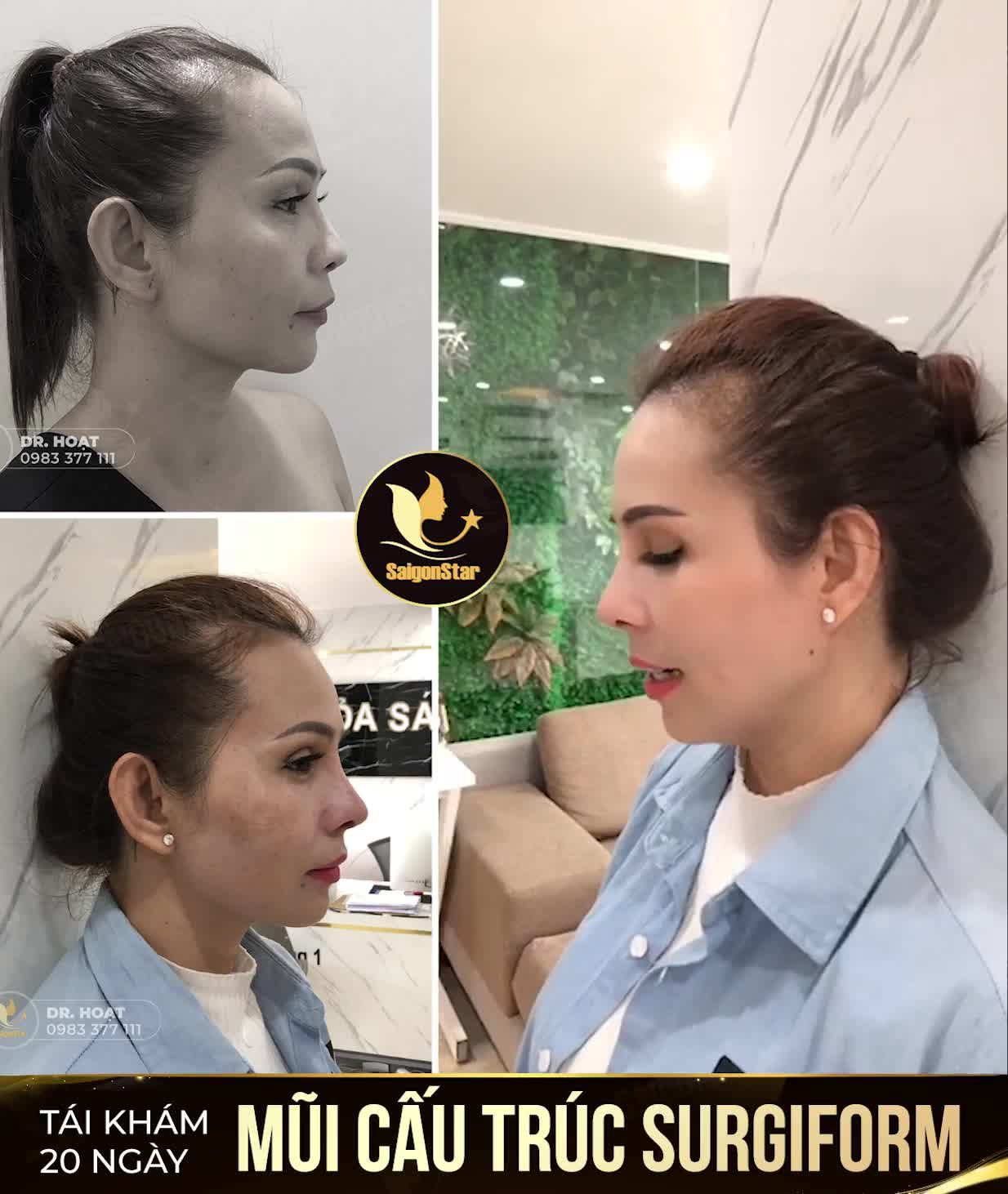 TÁI KHÁM 20 NGÀY MŨI CẤU TRÚC SURGIFORM