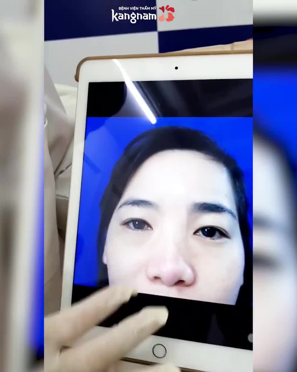 Bạn lo MÍ SƯNG LÂU ảnh hưởng đến công việc?