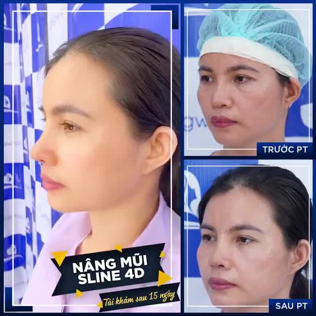 TÁI KHÁM DÁNG MŨI SLINE 4D 15 NGÀY - MŨI HẾT LỆCH, TỰ TIN VỚI DIỆN MẠO RẠNG RỠ