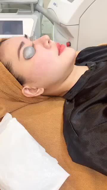 Sẹo rỗ - phương pháp điều trị với laser Ultrapulse ! Ưu đãi 20% - cả nhà nhanh tay đăng ký nhé .