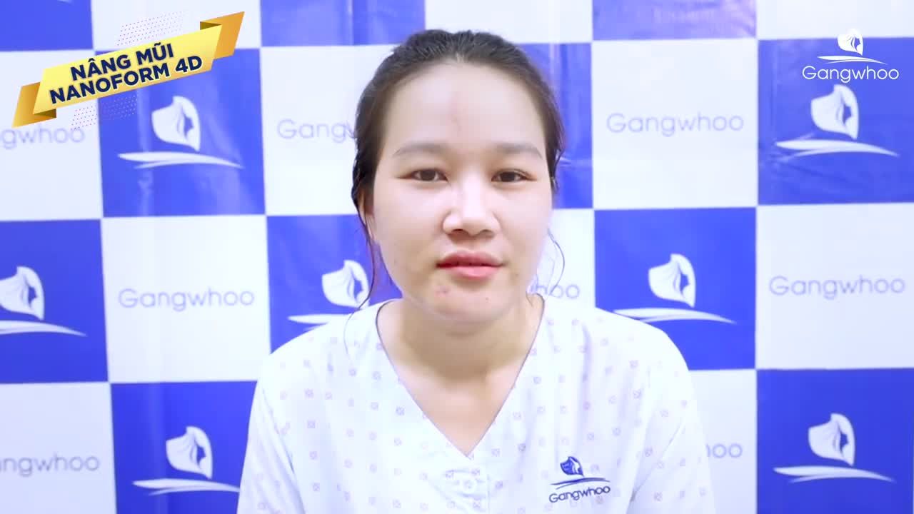 NÂNG MŨI NANOFORM CHỈNH LỆCH DO TAI NẠN - MŨI LÊN FORM, CAO BAY ĐẸP HOÀN HẢO