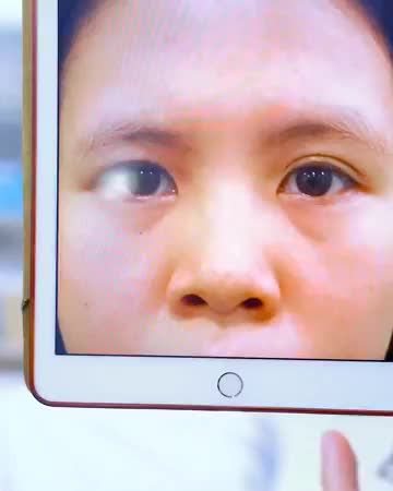 Cắt mí kết hợp chuyển mỡ mắt, mở rộng góc mắt. Một ca mí siêu khó nhưng mang tới kết quả siêu đẹp