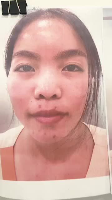 MŨI CẤU TRÚC SURGIFORM CHO ĐẦU MŨI NGẮN HẾCH