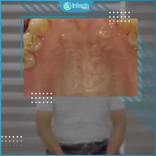 CHIẾC RĂNG KHÔN MỌC LỆCH “RỦ THEO” RĂNG SỐ 7 VÀ SỐ 6