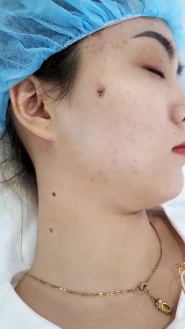 Điều trị nốt ruồi lồi "khủng" bằng công nghệ Laser CO2 tại Kangnam Chỉ từ 500k Đăng ký ngay thôi!