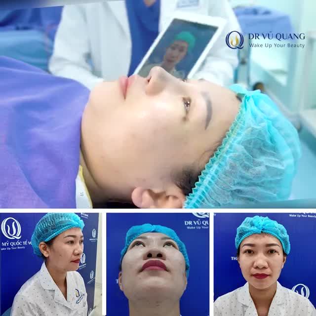 MŨI SOFTLINE VÀO FORM MÀ KHÔNG CẦN BĂNG NẸP – ĐẸP NGAY SAU KHI LÀM