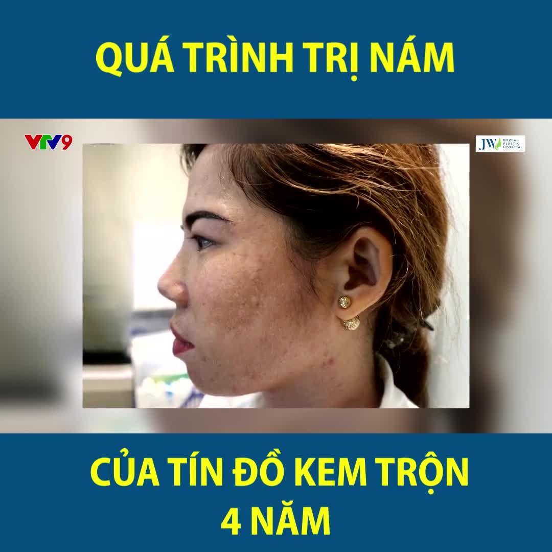 QUÁ TRÌNH TRỊ NÁM CỦA TÍN ĐỒ KEM TRỘN 4 NĂM