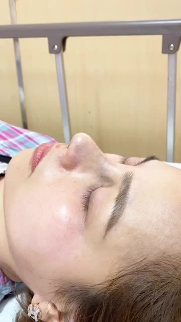 Thêm một ca mũi với tình trạng sống mũi gồ đã thay đổi hoàn toàn sau nâng mũi Sline.