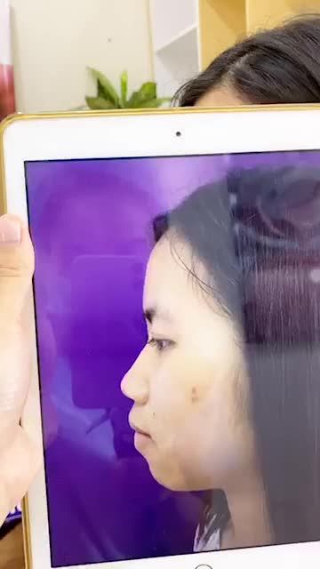 Kết quả nâng mũi Sline và độn cằm Vline cho bạn gái 18 tuổi vừa hoàn thành xong kỳ thi THPT QG.