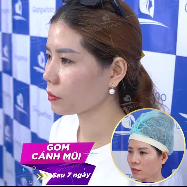 GOM CÁNH MŨI NỘI SOI - KHÔNG ĐỂ LẠI SẸO XẤU