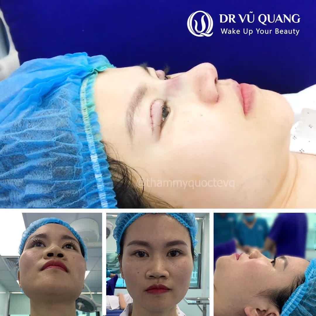 NHAN SẮC MỘC MẠC HÓA HOT GIRL SAU 60 PHÚT NÂNG MŨI CẮT MÍ KHÔNG ĐAU - KHÔNG SƯNG - KHÔNG CẦN NGHỈ DƯỠNG của Dr Vũ Quang.