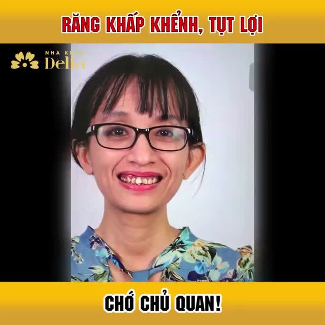 Răng khấp_khểnh khó vệ sinh, nhiều cao răng, mảng bám, ố vàng, gây tụt lợi, nhiều răng hư hỏng