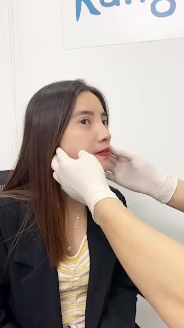 Tròn 1 năm sau combo CHỈNH HÀM HÔ + NÂNG MŨI + CẮT MÍ + CẤY MỠ của thí sinh HTLX Nguyễn Thị Huê