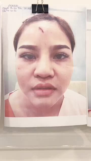 MŨI BỌC SỤN SỬA LẠI CÓ ĐAU KHÔNG?