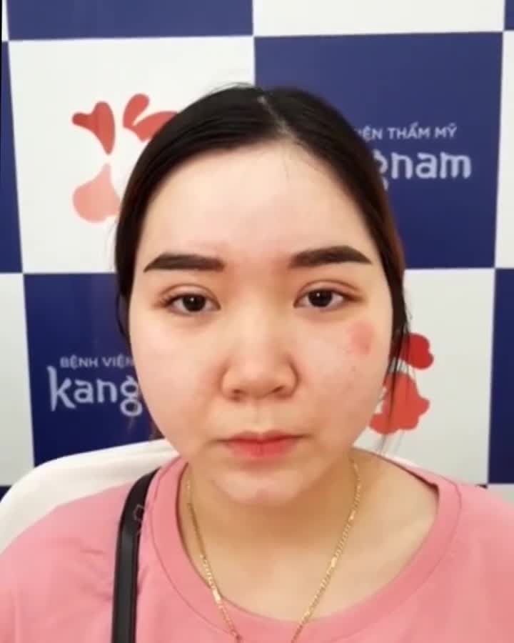 7 ngày sau CẮT MÍ  Vừa Cắt Chỉ đã có ngay MÍ XINH
